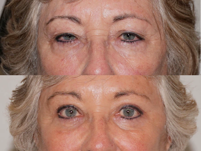 Before and After