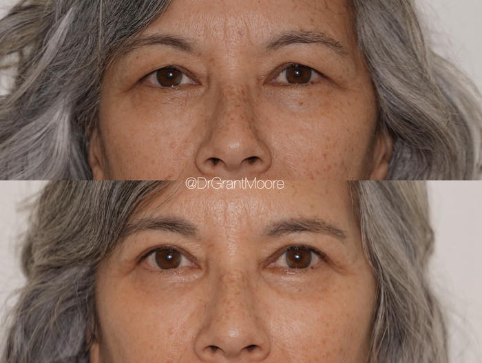 Before and After