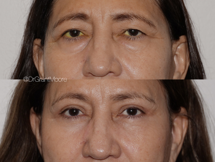 Before and After