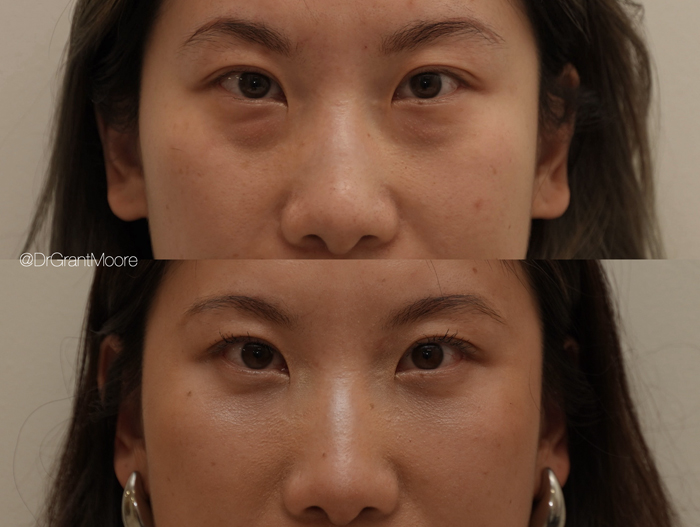 Before and After